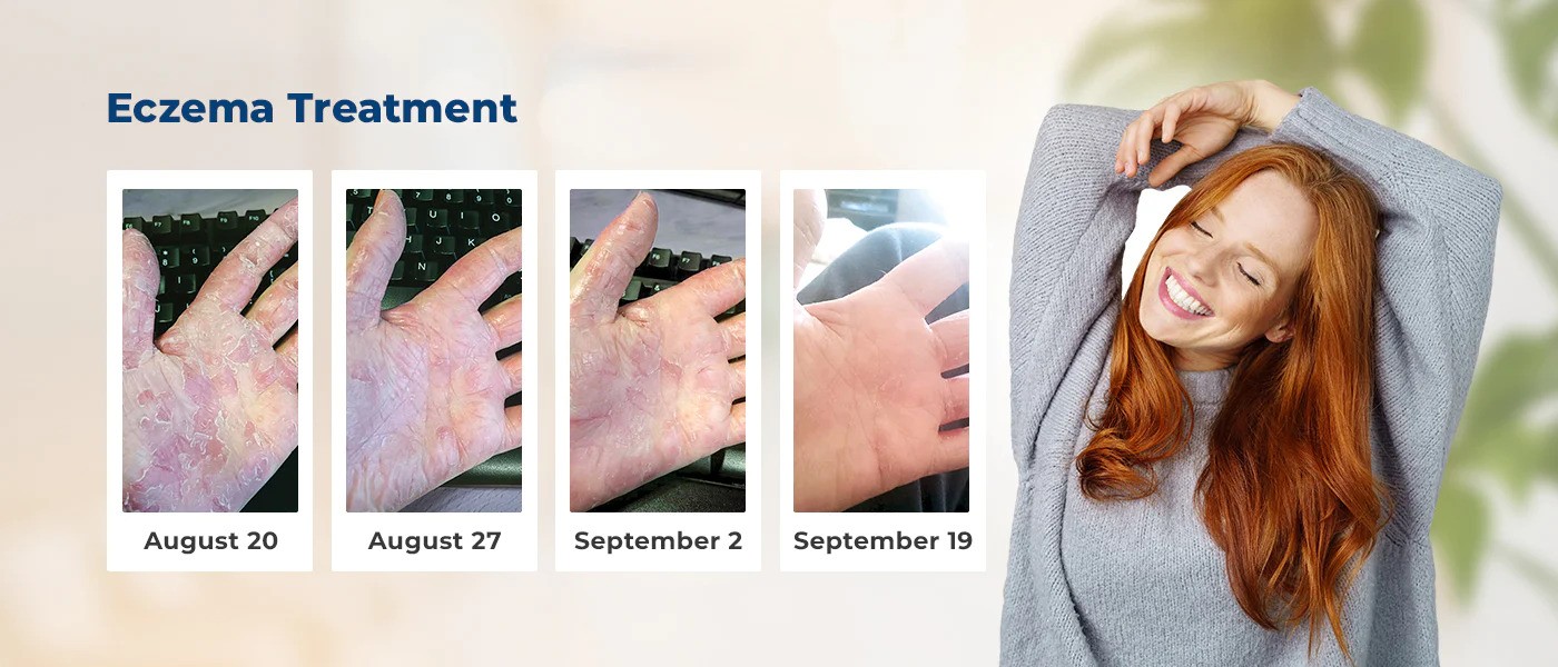Before and after eczema treatment progress photos for gloves in a bottle user