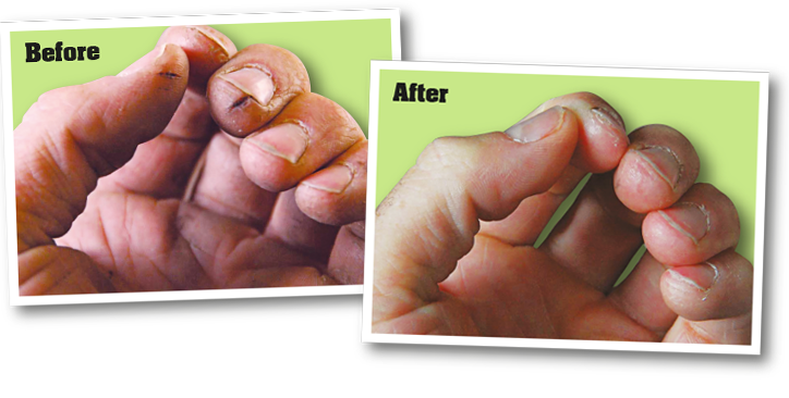 O’Keeffe’s Working Hands Cream was applied before bed and three times daily for two weeks Before and After Hand Images